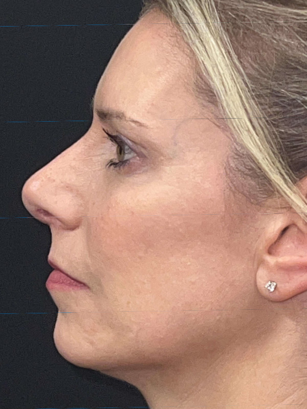 Rhinoplasty Before and After | Princeton Plastic Surgeons