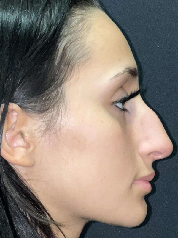 Rhinoplasty Before and After | Princeton Plastic Surgeons