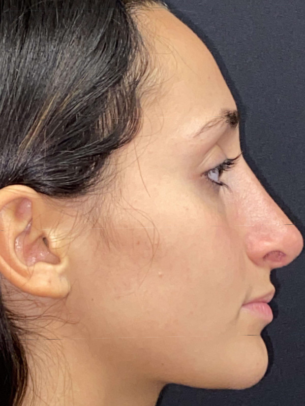 Rhinoplasty Before and After | Princeton Plastic Surgeons