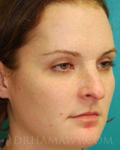 Rhinoplasty Before and After | Princeton Plastic Surgeons