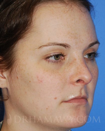 Rhinoplasty Before and After | Princeton Plastic Surgeons