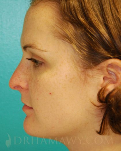 Rhinoplasty Before and After | Princeton Plastic Surgeons