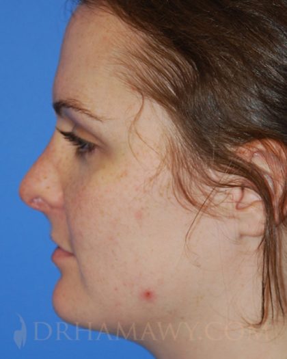 Rhinoplasty Before and After | Princeton Plastic Surgeons