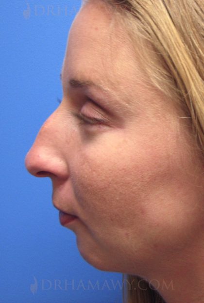 Rhinoplasty Before and After | Princeton Plastic Surgeons