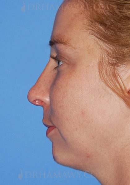 Rhinoplasty Before and After | Princeton Plastic Surgeons