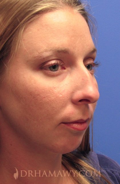 Rhinoplasty Before and After | Princeton Plastic Surgeons