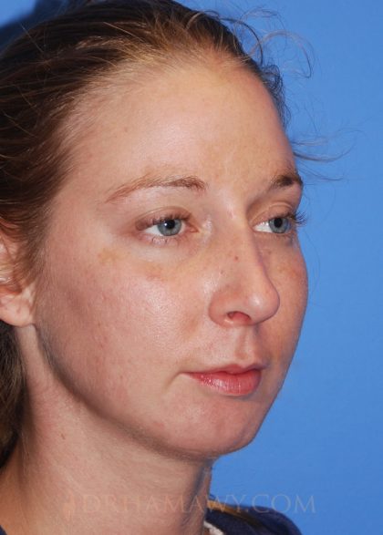 Rhinoplasty Before and After | Princeton Plastic Surgeons