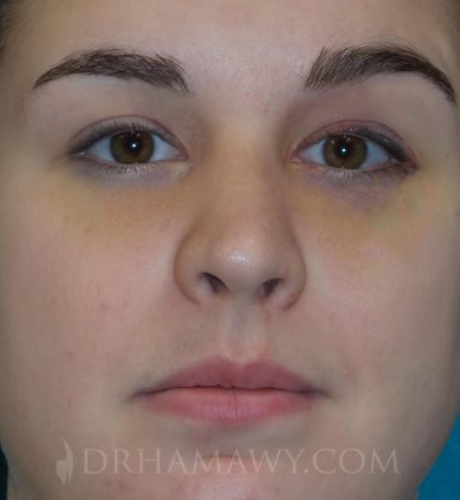 Rhinoplasty Before and After | Princeton Plastic Surgeons