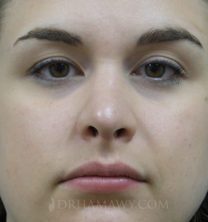 Rhinoplasty Before and After | Princeton Plastic Surgeons