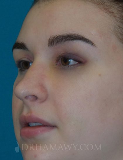 Rhinoplasty Before and After | Princeton Plastic Surgeons