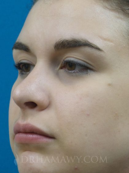 Rhinoplasty Before and After | Princeton Plastic Surgeons