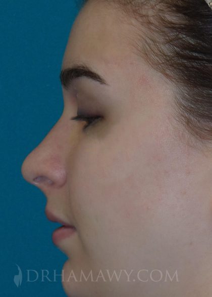 Rhinoplasty Before and After | Princeton Plastic Surgeons