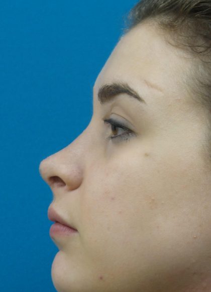 Rhinoplasty Before and After | Princeton Plastic Surgeons