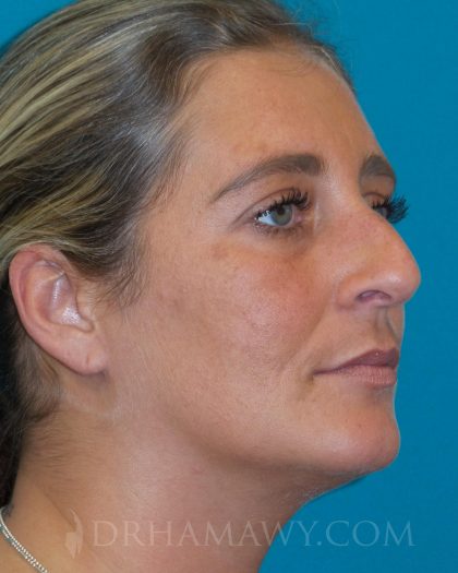 Rhinoplasty Before and After | Princeton Plastic Surgeons