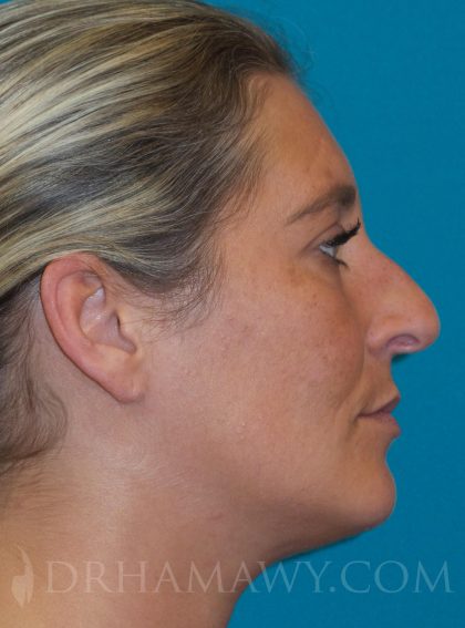 Rhinoplasty Before and After | Princeton Plastic Surgeons