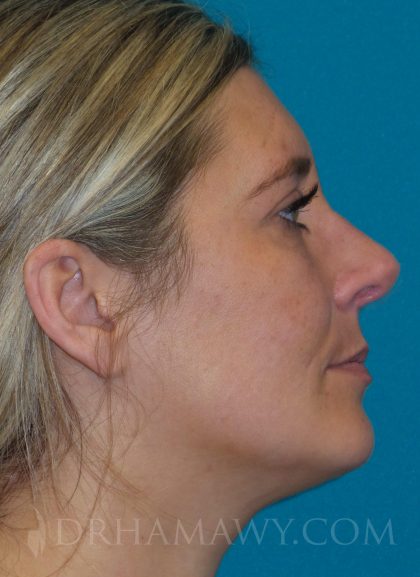 Rhinoplasty Before and After | Princeton Plastic Surgeons