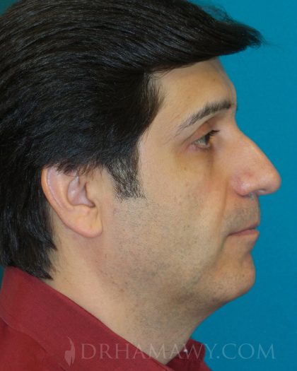 Rhinoplasty Before and After | Princeton Plastic Surgeons