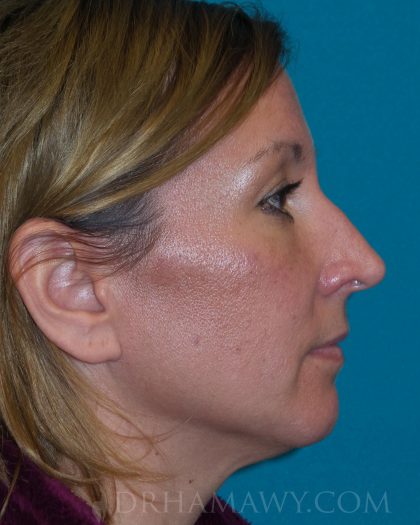 Rhinoplasty Before and After | Princeton Plastic Surgeons