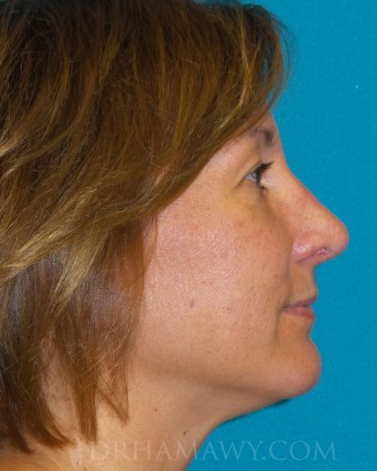 Rhinoplasty Before and After | Princeton Plastic Surgeons