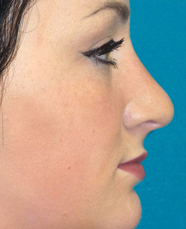 Rhinoplasty Before and After | Princeton Plastic Surgeons