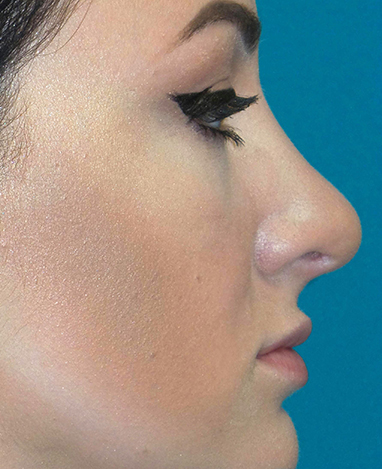 Rhinoplasty Before and After | Princeton Plastic Surgeons