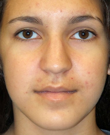 Rhinoplasty Before and After | Princeton Plastic Surgeons