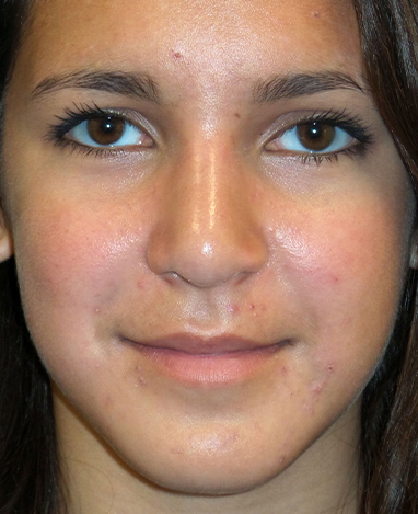 Rhinoplasty Before and After | Princeton Plastic Surgeons