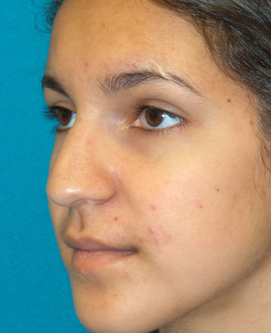 Rhinoplasty Before and After | Princeton Plastic Surgeons