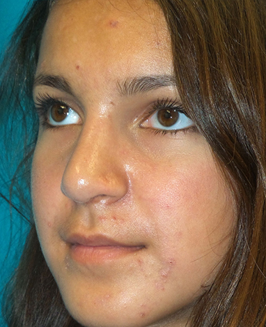 Rhinoplasty Before and After | Princeton Plastic Surgeons