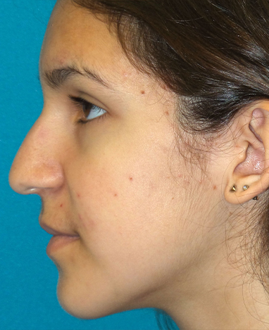 Rhinoplasty Before and After | Princeton Plastic Surgeons