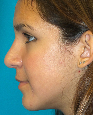 Rhinoplasty Before and After | Princeton Plastic Surgeons