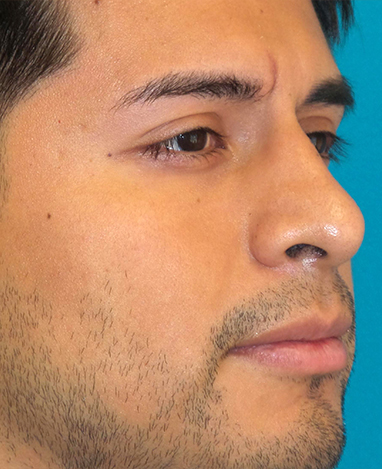 Rhinoplasty Before and After | Princeton Plastic Surgeons