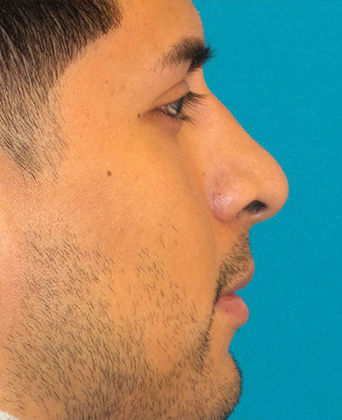 Rhinoplasty Before and After | Princeton Plastic Surgeons