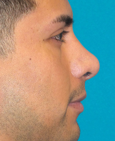 Rhinoplasty Before and After | Princeton Plastic Surgeons