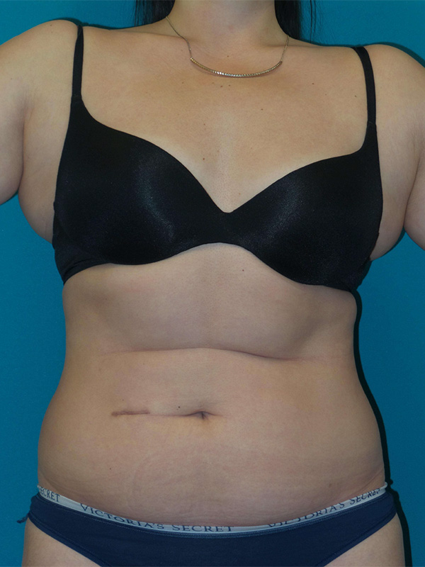 Smartlipo Before and After | Princeton Plastic Surgeons
