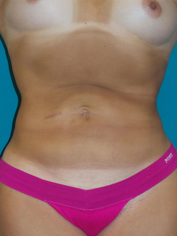 Smartlipo Before and After | Princeton Plastic Surgeons