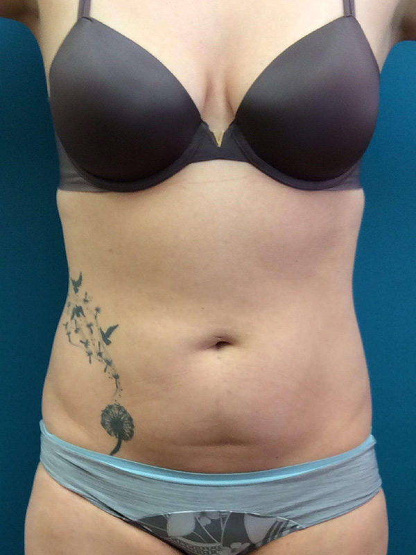 Smartlipo Before and After | Princeton Plastic Surgeons