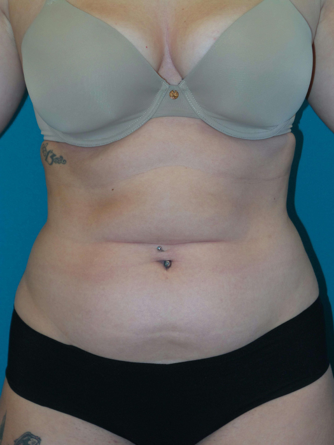 Smartlipo Before and After | Princeton Plastic Surgeons