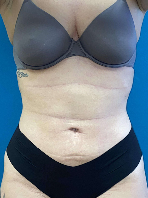 Smartlipo Before and After | Princeton Plastic Surgeons