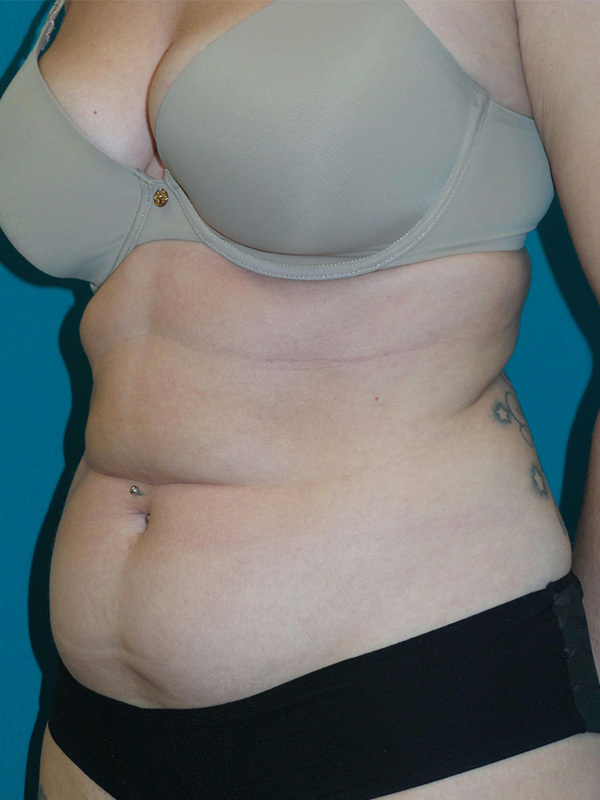 Smartlipo Before and After | Princeton Plastic Surgeons