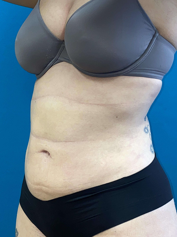 Smartlipo Before and After | Princeton Plastic Surgeons