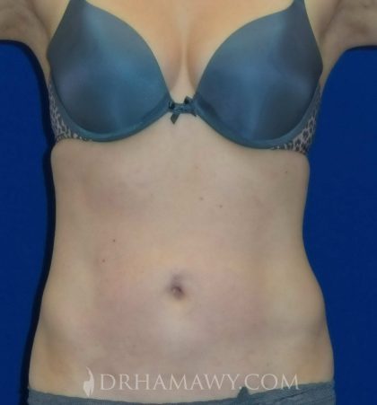 Smartlipo Before and After | Princeton Plastic Surgeons