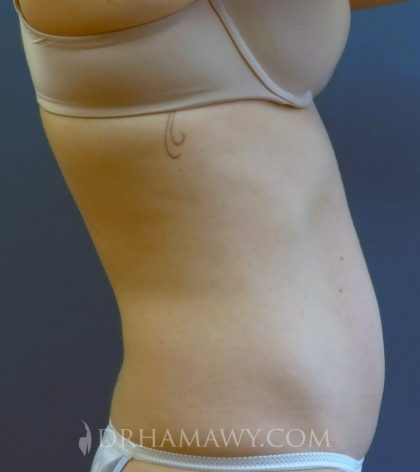 Smartlipo Before and After | Princeton Plastic Surgeons