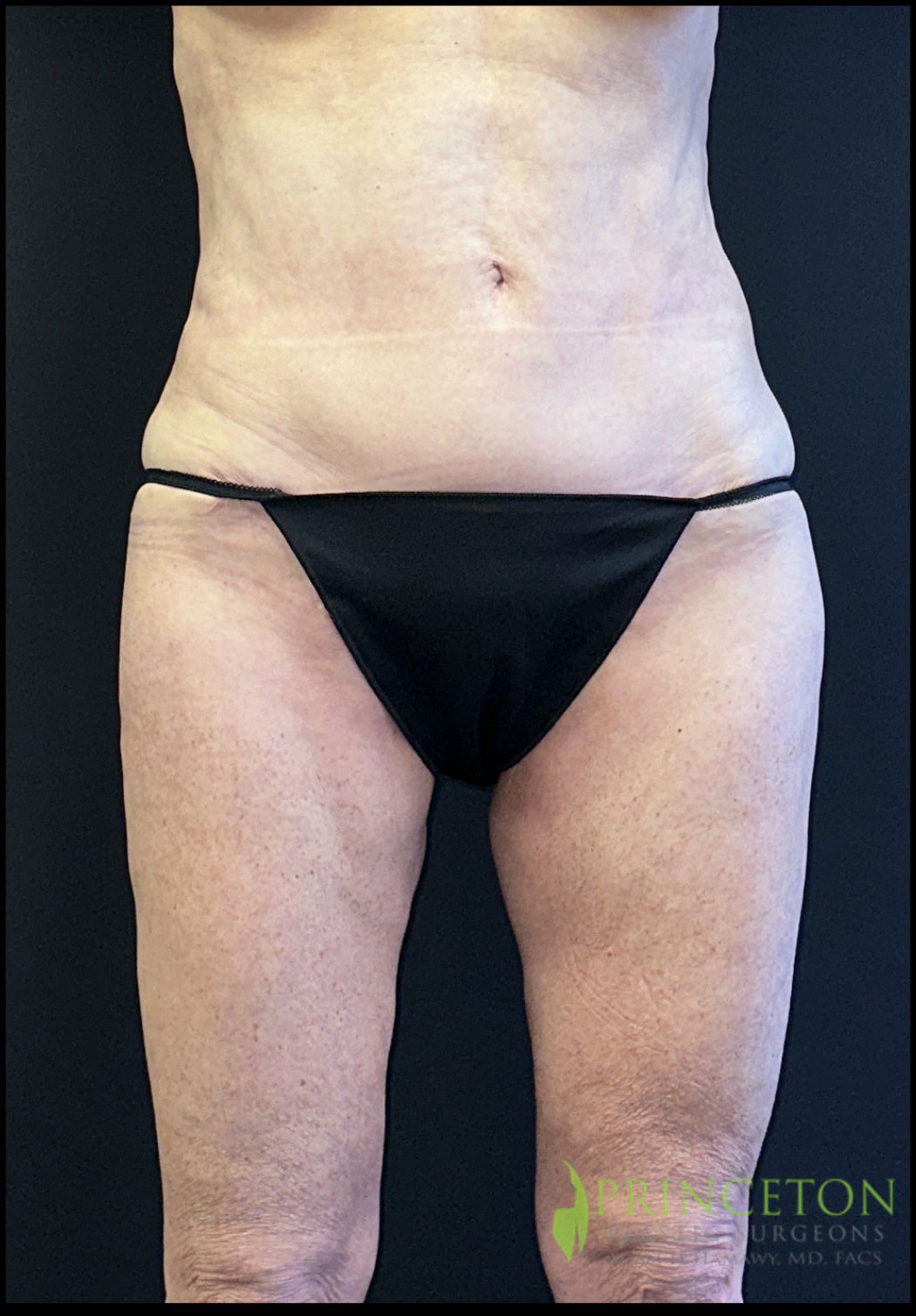 Thigh Lift Before and After | Princeton Plastic Surgeons