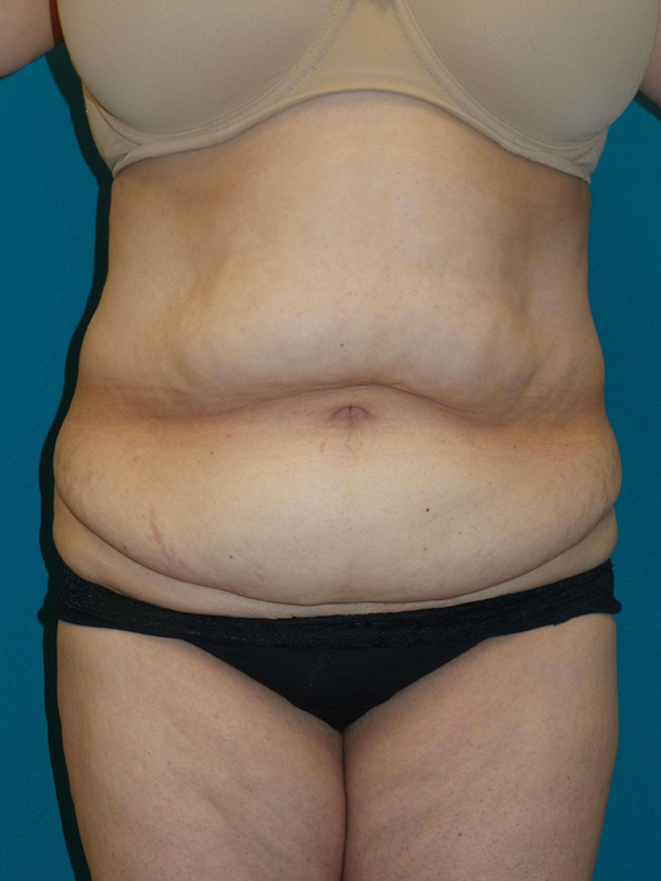 Tummy Tuck Before and After | Princeton Plastic Surgeons