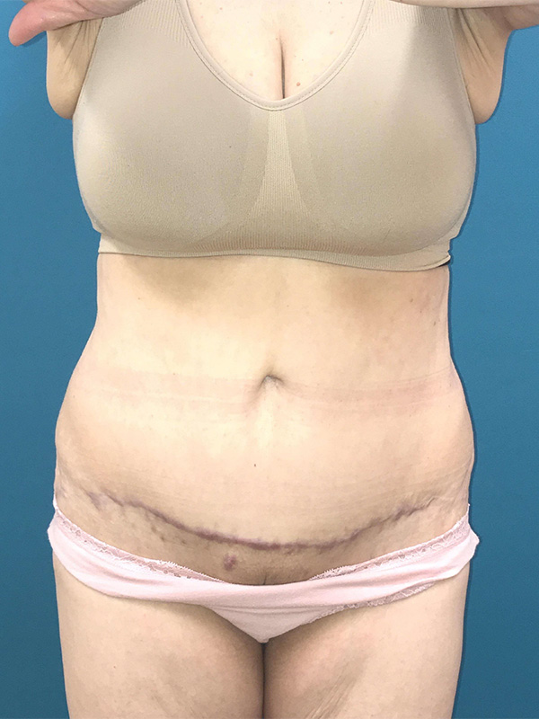 Tummy Tuck Before and After | Princeton Plastic Surgeons