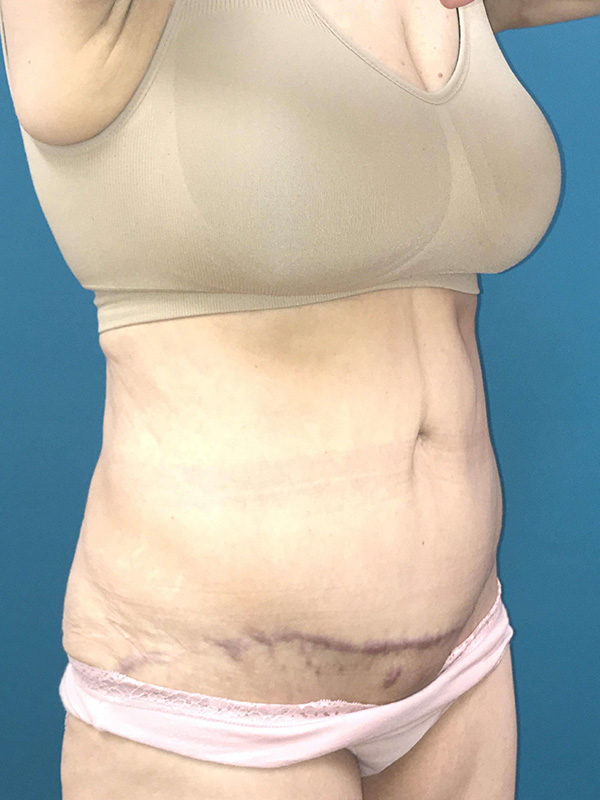 Tummy Tuck Before and After | Princeton Plastic Surgeons