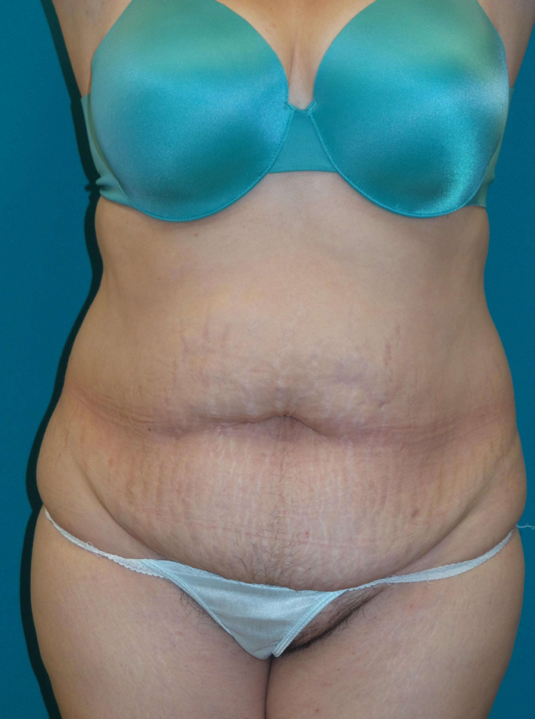 Tummy Tuck Before and After | Princeton Plastic Surgeons