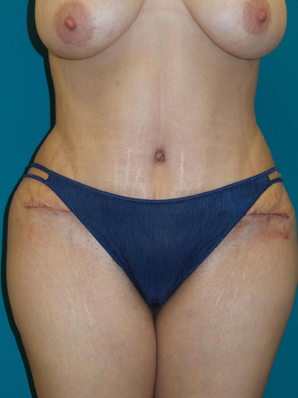 Tummy Tuck Before and After | Princeton Plastic Surgeons