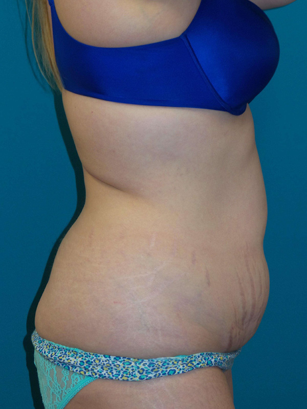 Tummy Tuck Before and After | Princeton Plastic Surgeons